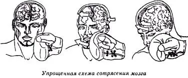 Сотрясение и контузия головного мозга Контузии мозга и его сотрясение - фото 54