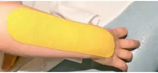 б в Рис 31 4 Стимуляционный тейпинг задней группы мышц плеча рис 32 - фото 60