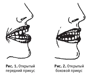 Открытый боковой прикус при смыкании резцов между коренными зубами с одной - фото 2
