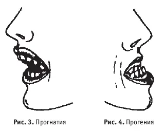 Прогения Аномалии в строении зубов редкое расположение зубов - фото 3