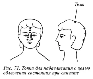 Для облегчения состояния надавливайте с обеих сторон носа на лоб теменную - фото 43