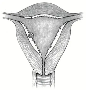 Имплантация эмбриона В момент оплодотворения определяется пол будущего ребенка - фото 13