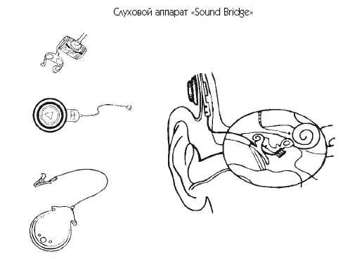 Рис 34 Имплантируемые слуховые аппараты Sound Bridge MEDEL и Baha - фото 49