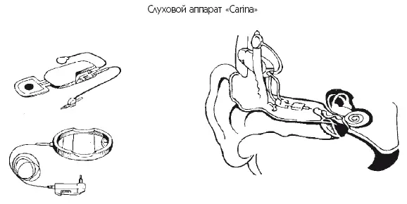 Рис 34 Имплантируемые слуховые аппараты Sound Bridge MEDEL и Baha - фото 51