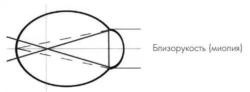 Рис 2 в То насколько существенно снижается зрение при близорукости зависит - фото 19
