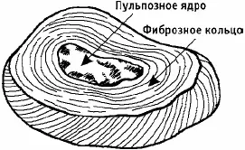 Рис 4Межпозвонковый диск Диск состоит из пульпозного ядра напоминающего по - фото 4