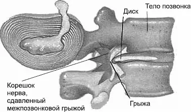 Рис 8Грыжа межпозвонковая В большинстве случаев это заболевание встречается у - фото 8