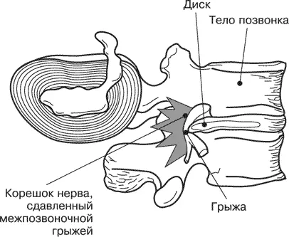 Рис 15 Грыжа межпозвоночная Межпозвоночная грыжа может быть шейной грудной - фото 8