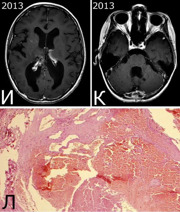 Рис 28IIIБная Кя 1988 г р Радиоиндуцированная кавернозная мальформация - фото 35