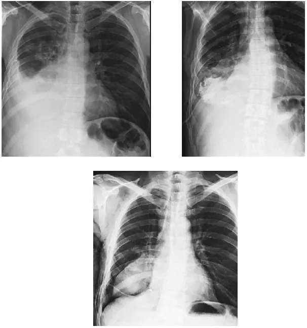 Рис 3 Рентгенологическая картина пациента М при первичном обращении выпот в - фото 5