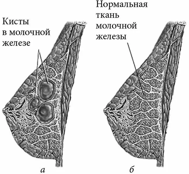 Рис 25Кисты в молочной железе а кисты в молочной железе б нормальная - фото 28