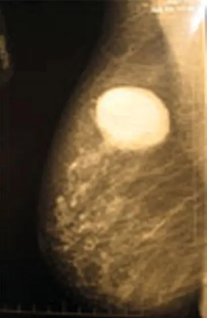 Рис 26Рак молочной железы симулирующий огромную кисту Клинические - фото 29