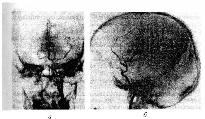 Рис 6 Ангиограмма артериальная фаза пострадавшего с очагом размозжения - фото 7