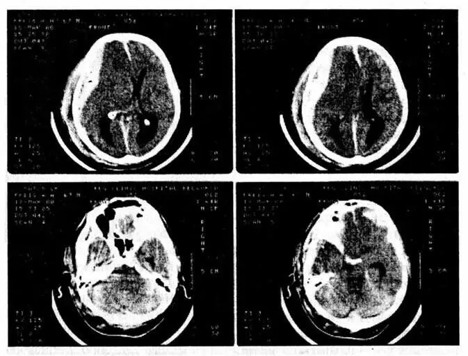 Рис 15 Компьютерная томограмма при субдуральной гематоме Рис 16 - фото 21