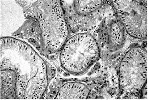 Рис 215 Синдром одних клеток Сертоли Гипосперматогенез рис 213 - фото 17