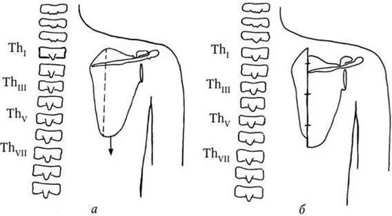 Рис 6 Способ лечения по методу F Konig а продольная остеотомия лопатки и - фото 6