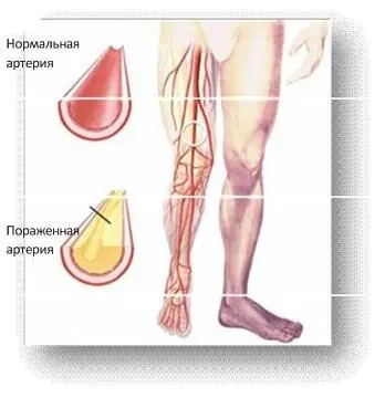 Рисунок 3 Артериосклероз астма см рисунок 4 Рисунок 4 Астма - фото 9
