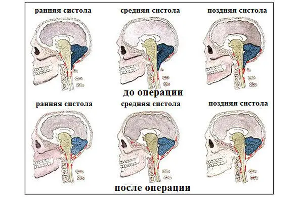 Рисунок 11Схематическое изображение пульсации ликвора на верхнешейном уровне - фото 1