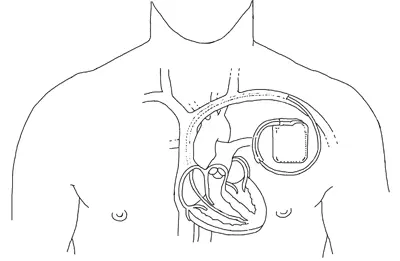 Кардиостимулятор Единственное лечение установка кардиостимулятора Операция - фото 4
