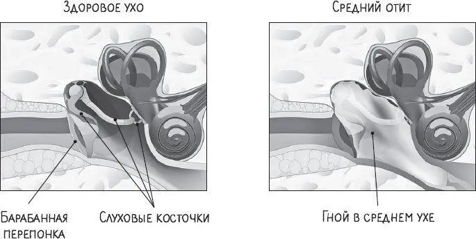 ОСТРЫЙ СРЕДНИЙ ОТИТ 3 повышение температуры тела 4 гнойные выделения из уха - фото 5