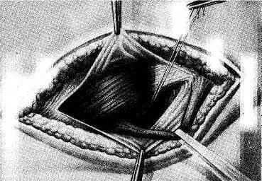Рис 78 Операция при косой паховой грыже у женщины ERhen Шейку грыжевого - фото 104