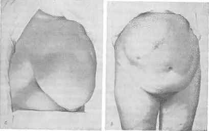 Рис 100 а большая послеоперационная вентральная грыжа после операции по - фото 127