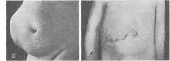Рис 38 Невропатическая грыжа у ребенка W Hecker а до операции б - фото 56