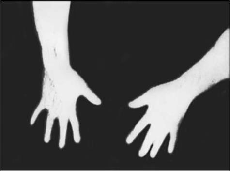 Рис 3а Термограмма верхних конечностей Пальцы кисти и предплечья в единой - фото 3