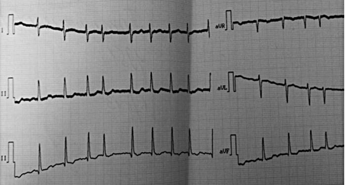 Рисунок 1 ЭКГ больного П 62 года от 05022013 г В стационаре пациенту - фото 1