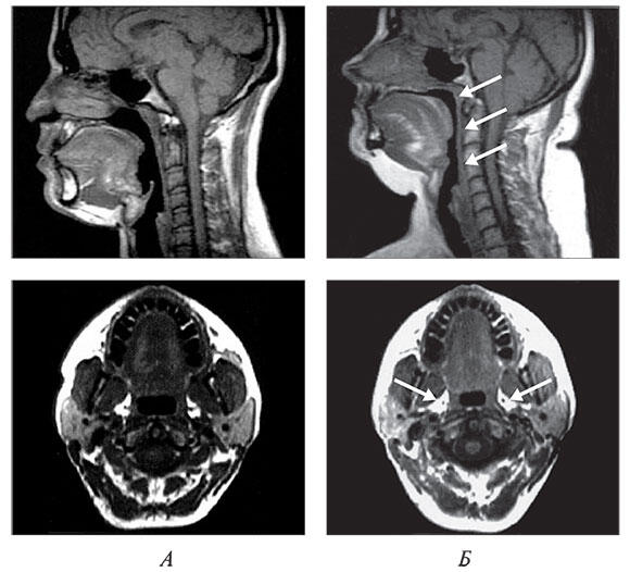 Рис 2 Сагиттальный и поперечный срез головы в норме А и у пациента с - фото 5