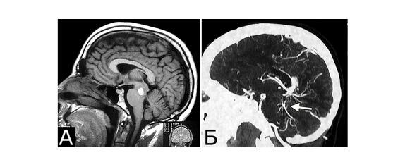Рис 10II Сочетание кавернозной и венозной мальформаций КМ среднего мозга - фото 15