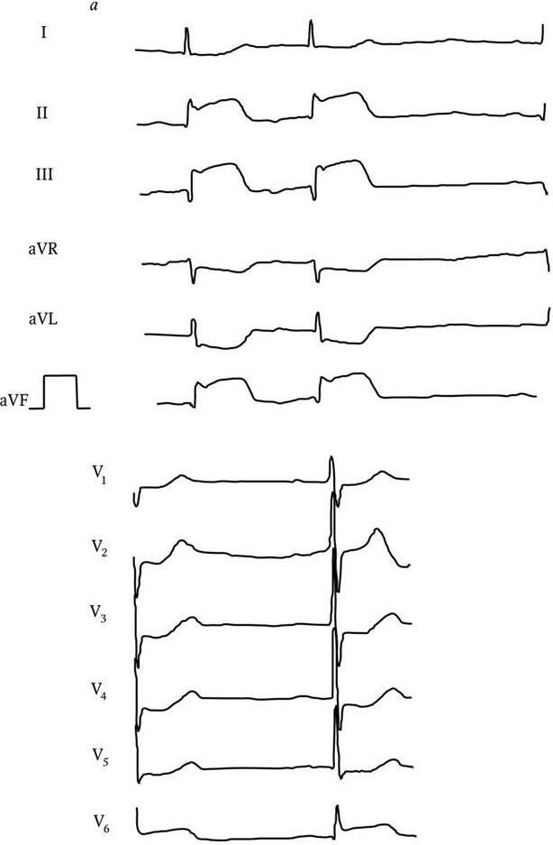 Рис 3 Электрокардиограммы больной Гвой с острым трансмуральным инфарктом - фото 3