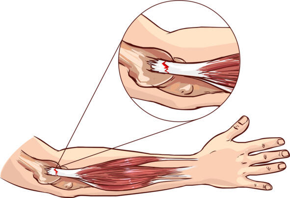 Рис1 Болезнь возникает изза повреждения сухожилий крепящих мышцы разгибатели - фото 1