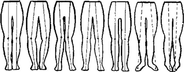 Рис 12 Варианты искривленных ног Исправить подобные кривые ноги не - фото 13